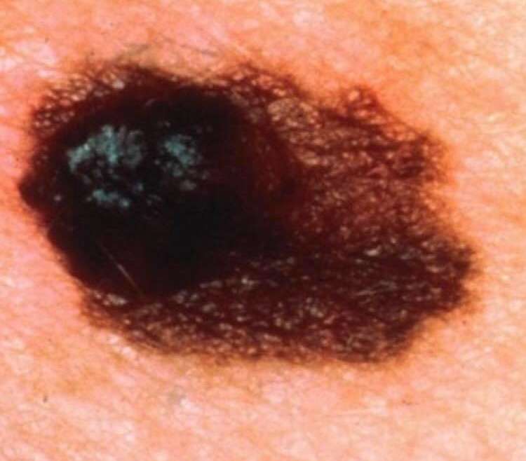 Il Melanoma