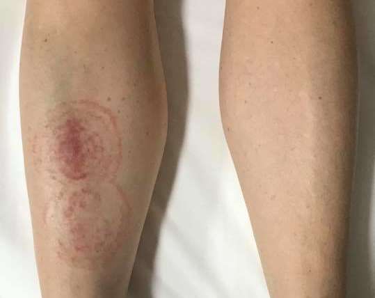 Tinea Corporis