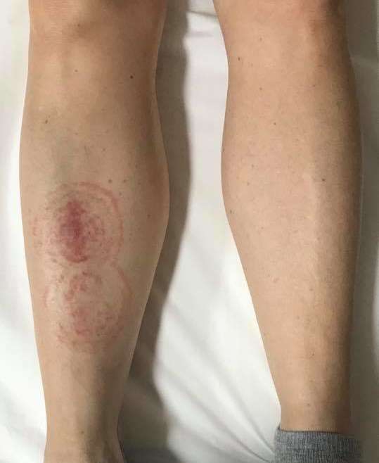Tinea Corporis